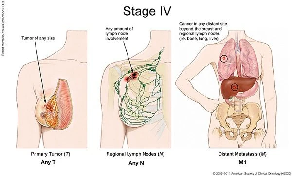 Hiểu rõ hơn về ung thư vú di căn, các thách thức và giải pháp