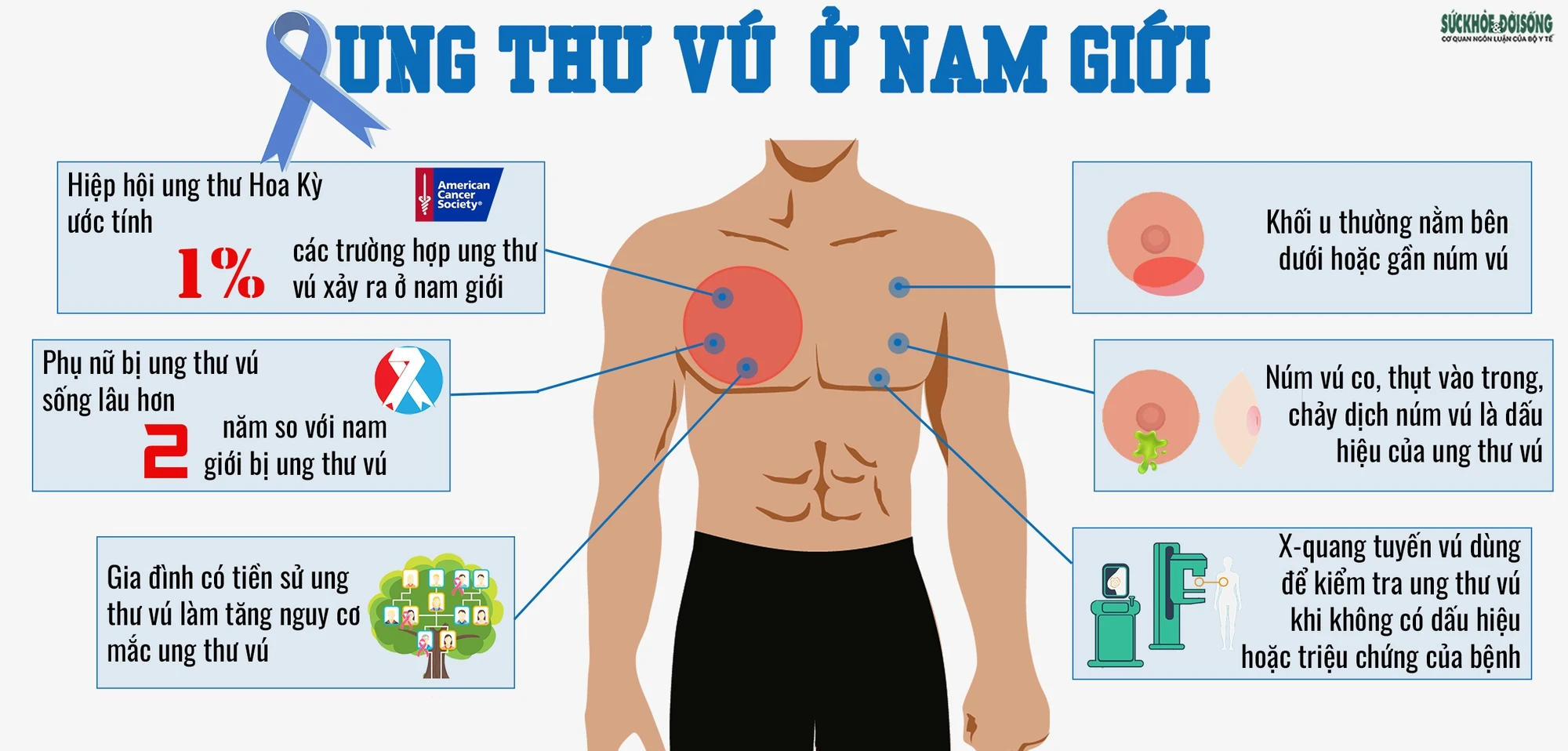 Tổng quan về điều trị ung thư vú ở nam giới